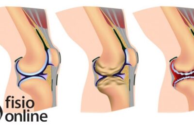 progen una solucion para articulaciones danadas