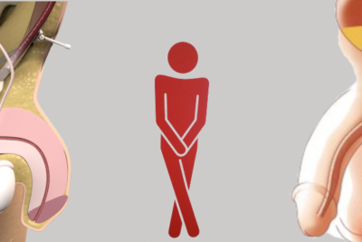 soluciones de incontinencia urinaria para hombres