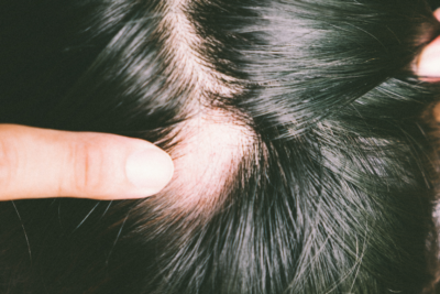 un estudio de una enfermedad de la piel revela una de las causas de la alopecia